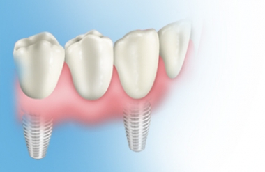 Implantat Teilbezahnung